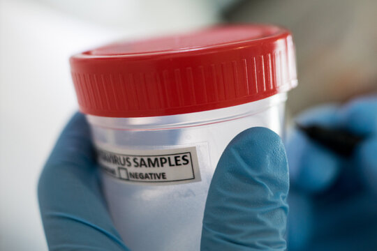 Extreme close up of a laboratory technician marking a medical specimen cup labeled explicitly for hantavirus samples.