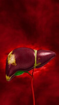 Liver with fat infiltration demonstrating steatosis stage of fatty liver disease highlighting lipid accumulation, metabolic dysfunction, and early liver damage associated with obesity. 3D conceptual.

