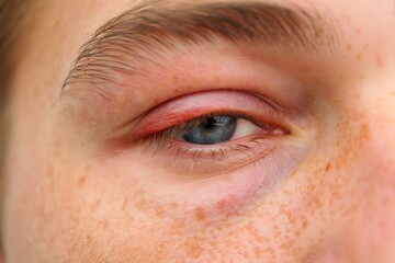 Obraz premium Close up of a blue eye with a swollen red eyelid and freckled skin image