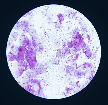 HVS for gram stain. Gram positive bacilli seen. Suggestive of lactobacilli.