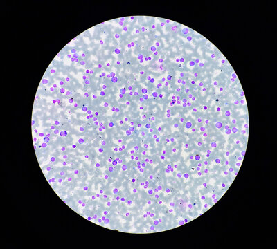 Features suggestive of Chronic Myeloid Leukaemia (Chronic phase). Microscopic image of blood cells. 