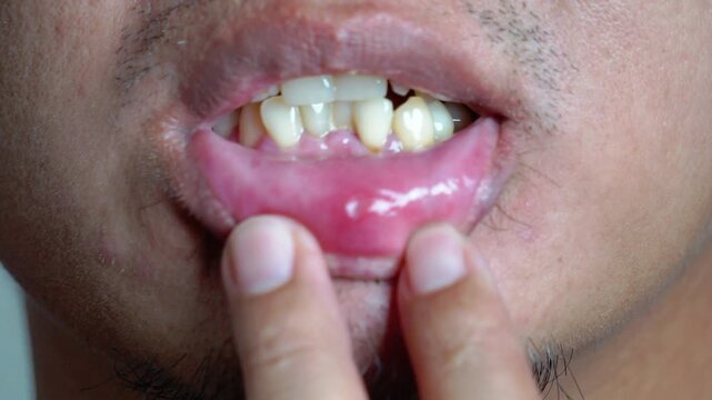 An Asian man is suffering from a canker sore. Examining the condition of his canker sore lip.