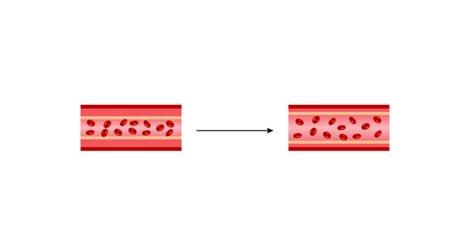 ACE inhibitors. Renin-Angiotensin-Aldosterone System, blood pressure regulation. Hypertension, Constricted and relaxed blood vessel. Vasoconstriction and vasodilatation. Vector illustration.