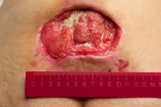 Close-up medical image of a severe stage 4 pressure ulcer (bedsore, decubitus ulcer) with granulation tissue and necrotic areas on human skin. Ruler used for wound size measurement.