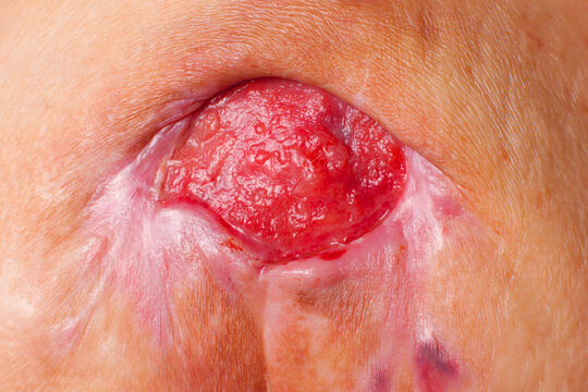 Close-up medical image of a severe stage 4 pressure ulcer (bedsore, decubitus ulcer) with granulation tissue and signs of chronic inflammation. Clinical wound care, surgery, rehabilitation 