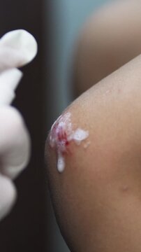 Close up a nurse's hand sprays an antiseptic agent on the child's knee wound. Wound treatment. First aid