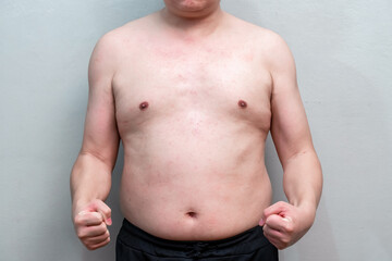 Naklejka premium The symptom of Dengue fever on skin of a man 39 years old, the detail of red spots and rash on the skin of a man in the recovery phase.