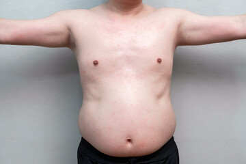Obraz premium skin rash and red spots on body of adult man during dengue fever infection and recovery period in Dec 2022.
