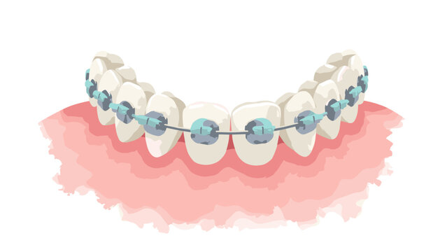 Orthodontic braces archwire bracket detail