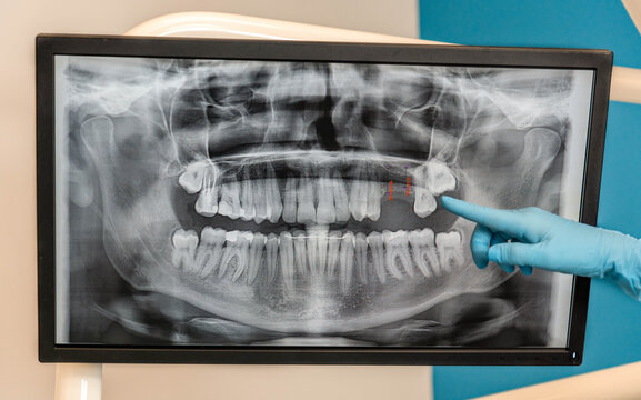 Dentist explaining panoramic dental x-ray results on monitor