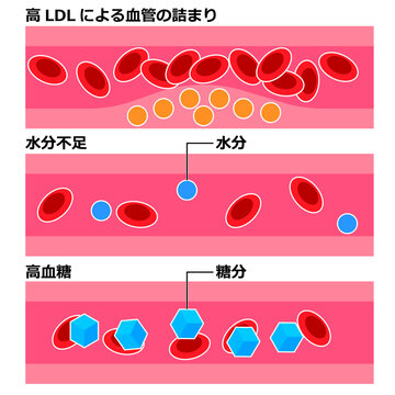 血液のドロドロの原因