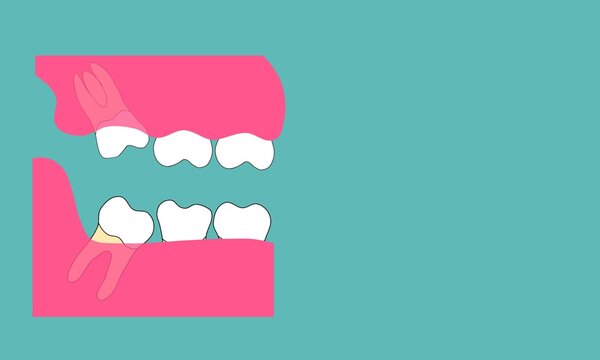 Upper and lower impacted wisdom teeth