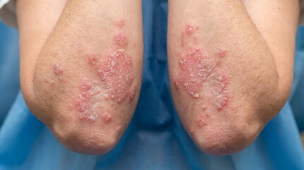 Fototapeta premium Close-up of Elbows affected by Psoriasis, a chronic skin condition, with red, scaly patches