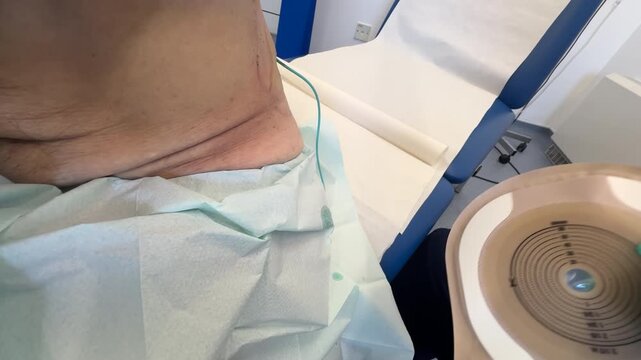 Close up of nurse hands mounting new pouch on nephrostomy tube and fitting the bag on man's body for left side kidney urine drainage.