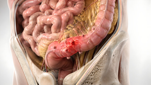 Diverticulitis in Sigmoid Colon 3D Medical Illustration for Digestive Health and Patient Education