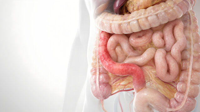 Crohn&rsquo;s Disease Terminal Ileum and Colon 3D Medical Illustration for Digestive Health Education and Patient Brochure Use