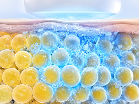 Abdomen fat freezing treatment illustration