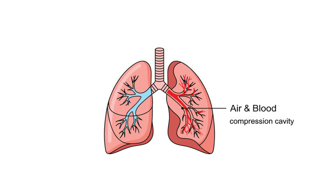 Anatomical illustration of human lungs with callout pointing to an air and blood compression cavity in right lung.
