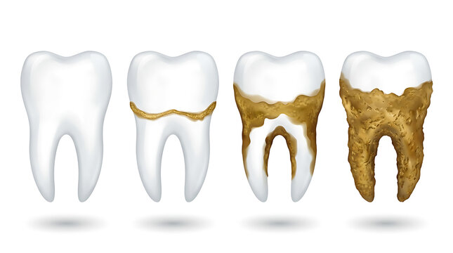 Progression of dental plaque and tartar buildup on human teeth illustrating the stages of tooth decay and oral disease - 3d illustration