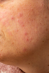 Fototapeta premium Red rash eczema on a woman face due to liver disease , close up texture