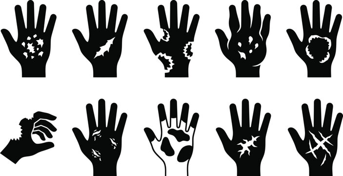 Hantavirus Silhouettes of hands showing various skin conditions and injuries injury wound