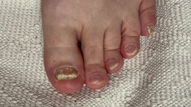 Onychomycosis. Dangerous fungal infection of human toenails on a white background at the doctor. Disease and detachment of the nail plate. Close-up