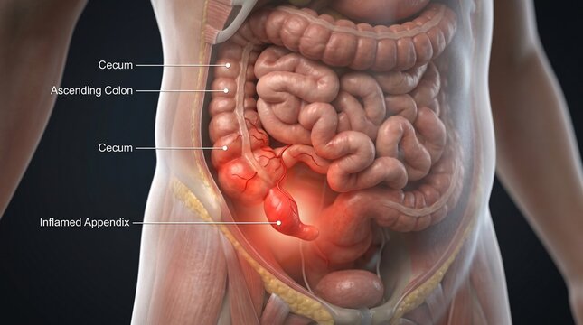 Anatomical illustration of the human abdomen showing the inflamed appendix and surrounding intestines
