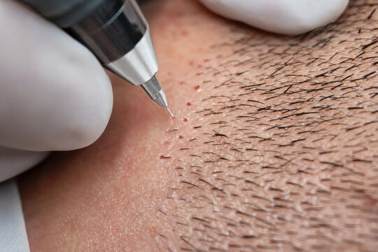 Macro shot of hair follicle extraction process during FUE hair transplant surgery.