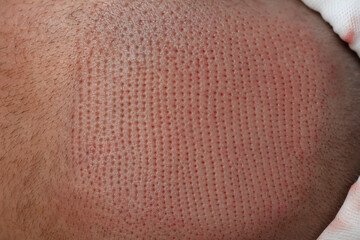 Fototapeta premium Close-up of healing scalp with micro incisions post follicular unit extraction.