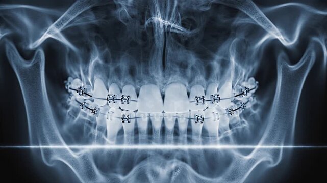 Panoramic Dental X Ray Medical Imaging Showing Orthodontic Braces Teeth Jaw Anatomy Oral Healthcare Diagnostic Footage