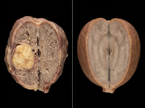 Kidney gross pathology comparison: renal cell carcinoma with internal tumor mass (left) and normal healthy kidney (right), gross anatomy specimen on black background.