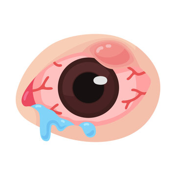 Cartoon graphic of an irritated, bloodshot eye with a swollen eyelid and watery discharge.