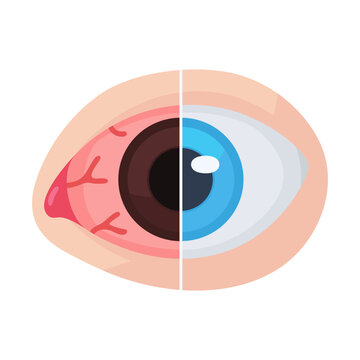 Visual comparison healthy blue eye versus irritated, red, bloodshot eye condition for health care.
