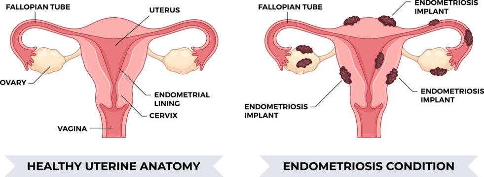Endometriosis Condition and Healthy Uterine Anatomy Medical Vector Illustration