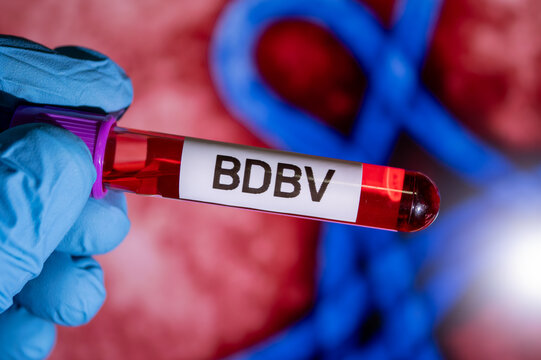 A hand in blue glove holds a blood sample vial of Bundibugyo ebolavirus (BDBV) in front of a biohazard sign.