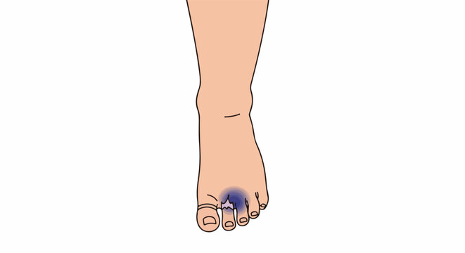 Stylized depiction of a human foot with the area around the big toe highlighted