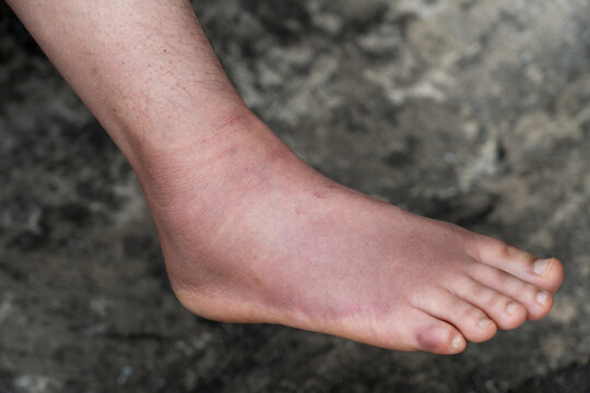 Swollen Foot After Cast Removal of Metatarsal Fracture