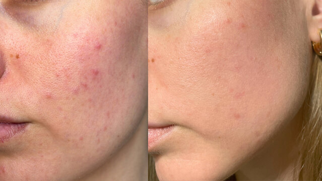 Side by side comparison of female facial skin before and after acne treatment. Close up of cheek with visible reduction of pimples, redness and skin irritation. Dermatology, skincare progress.