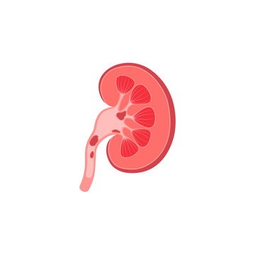 kidney stones illustration
