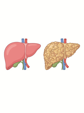 Comparison of Healthy Human Liver and Cirrhotic Liver Anatomy Isolated on White Background