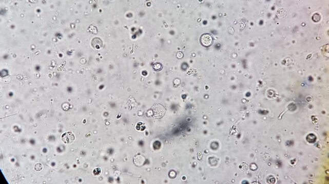 Oligozoospermia and asthenozoospermia with evidance of infection. Plenty of pus cells are seen. Microscopic footage of abnormal sparm count.