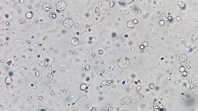 Oligozoospermia and asthenozoospermia with evidance of infection. Plenty of pus cells are seen. Microscopic footage of abnormal sparm count.