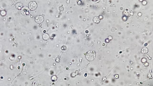 Oligozoospermia and asthenozoospermia with evidance of infection. Plenty of pus cells are seen. Microscopic footage of abnormal sparm count.