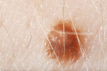 Fototapeta premium Macro view of skin with birthmark as background