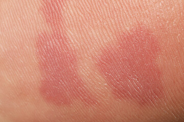 Fototapeta premium Macro view of skin with birthmarks as background