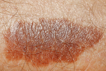 Fototapeta premium Macro view of skin with birthmark as background