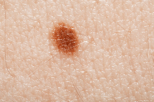 Macro view of skin with birthmark as background