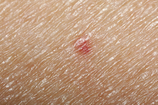 Macro view of skin with birthmark as background