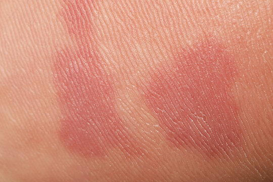 Macro view of skin with birthmarks as background