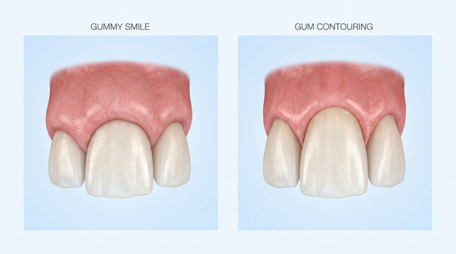 Esthetic Gummy Smile Reduction and Gingivectomy Dental Procedure Illustration